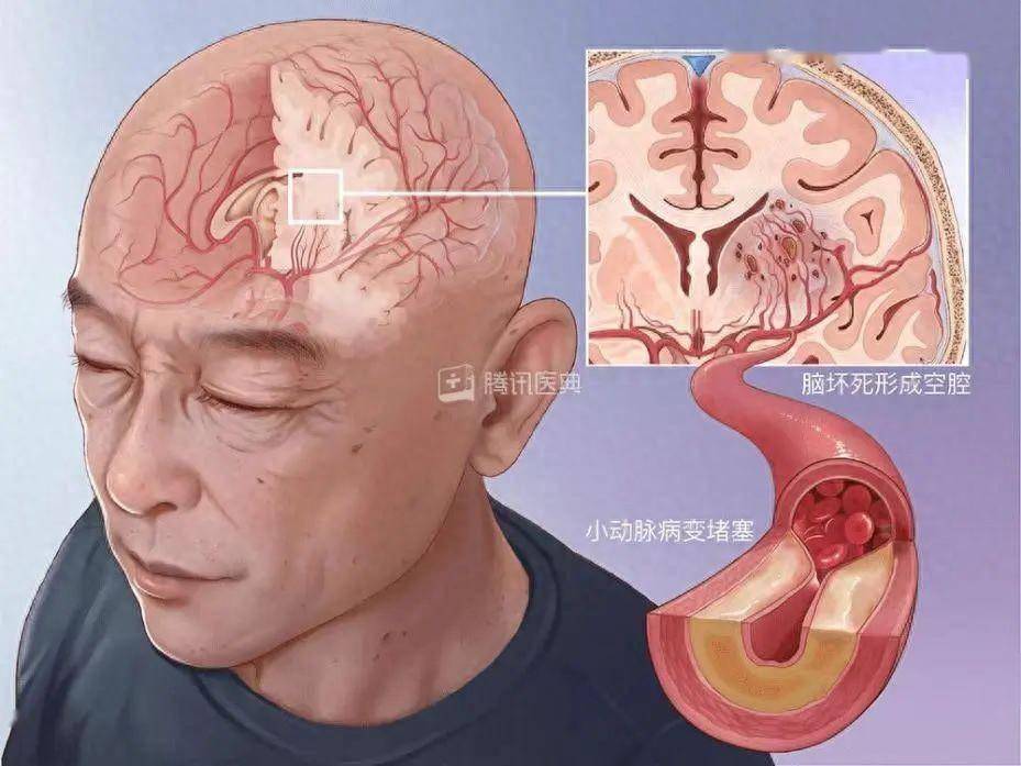 脑梗死位置图图片