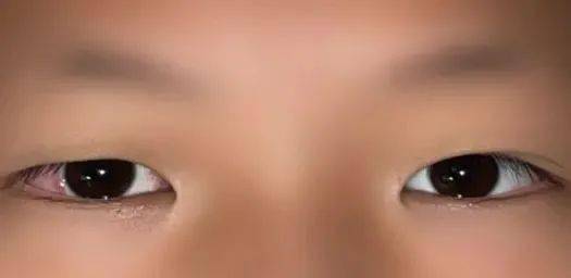 通宵玩手机,熬成"斗鸡眼"!医生:急需手术!_诸力伟_情况_杭州市