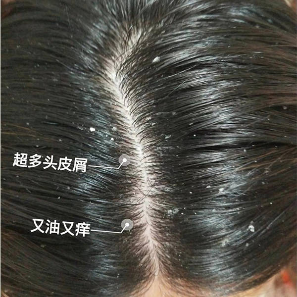 头发_头皮屑_成分
