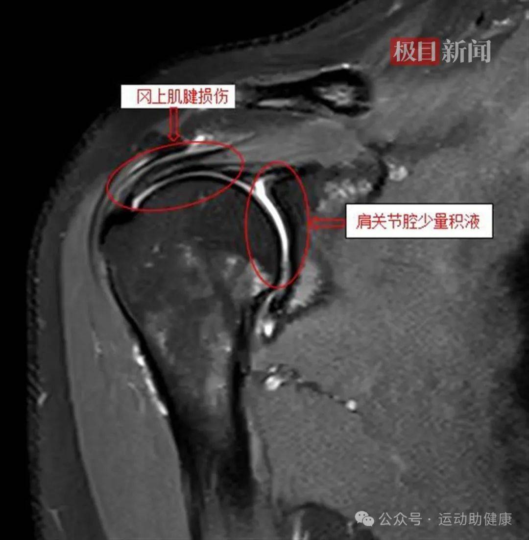 肩锁关节韧带断裂图片