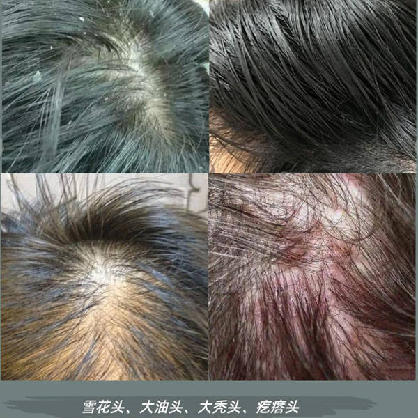 去头皮屑的洗发水排行榜_问题_去屑_清爽
