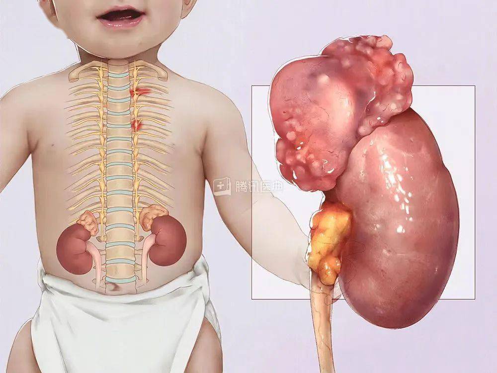 罕见病神经母细胞瘤到底是什么?_孩子_治疗_恶性肿瘤