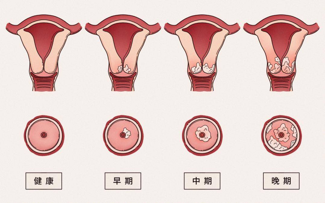 孕中期分泌物图片