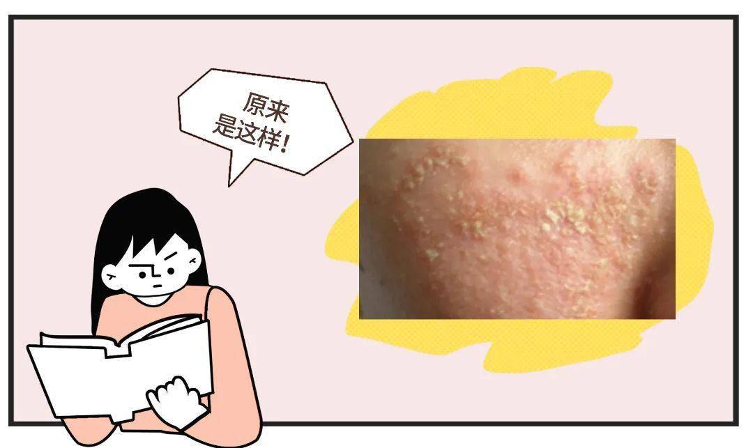 左滑查看图片→银屑病左滑查看图片→面癣左滑查看图片→多形性日光疹