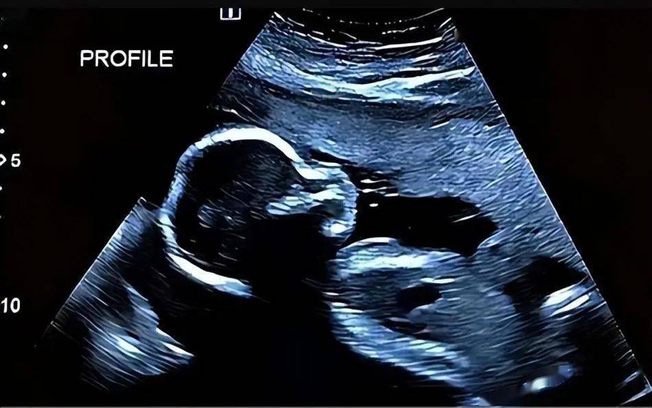 婴儿怪胎图片图片