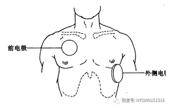 除颤仪三导联位置图片图片