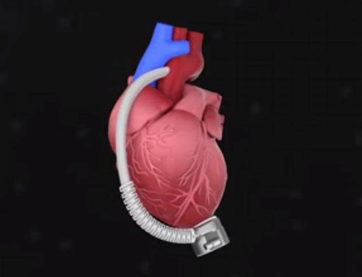 为制定精准的手术方案,心脏外科主任曹海龙教授组织麻醉手术与疼痛