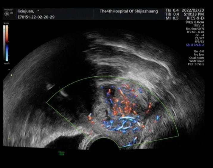 妇科超声遇到不规则出血