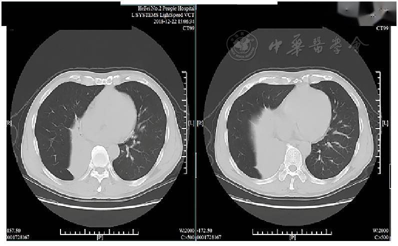 病例分享丨1例被诊断为支气管哮喘十余年的全身型嗜酸性肉芽肿性多
