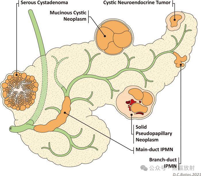 胰管型ipmn图片