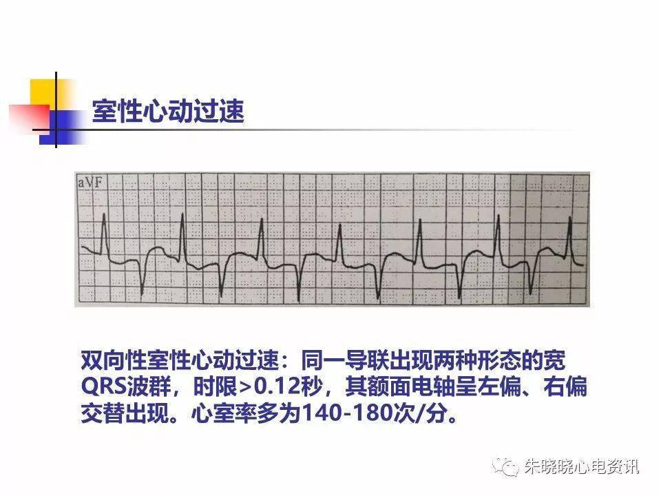 ppt危急值心电图详解