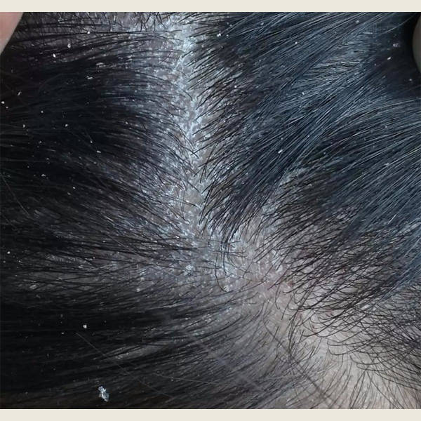 毛囊炎疙瘩用什么洗发水