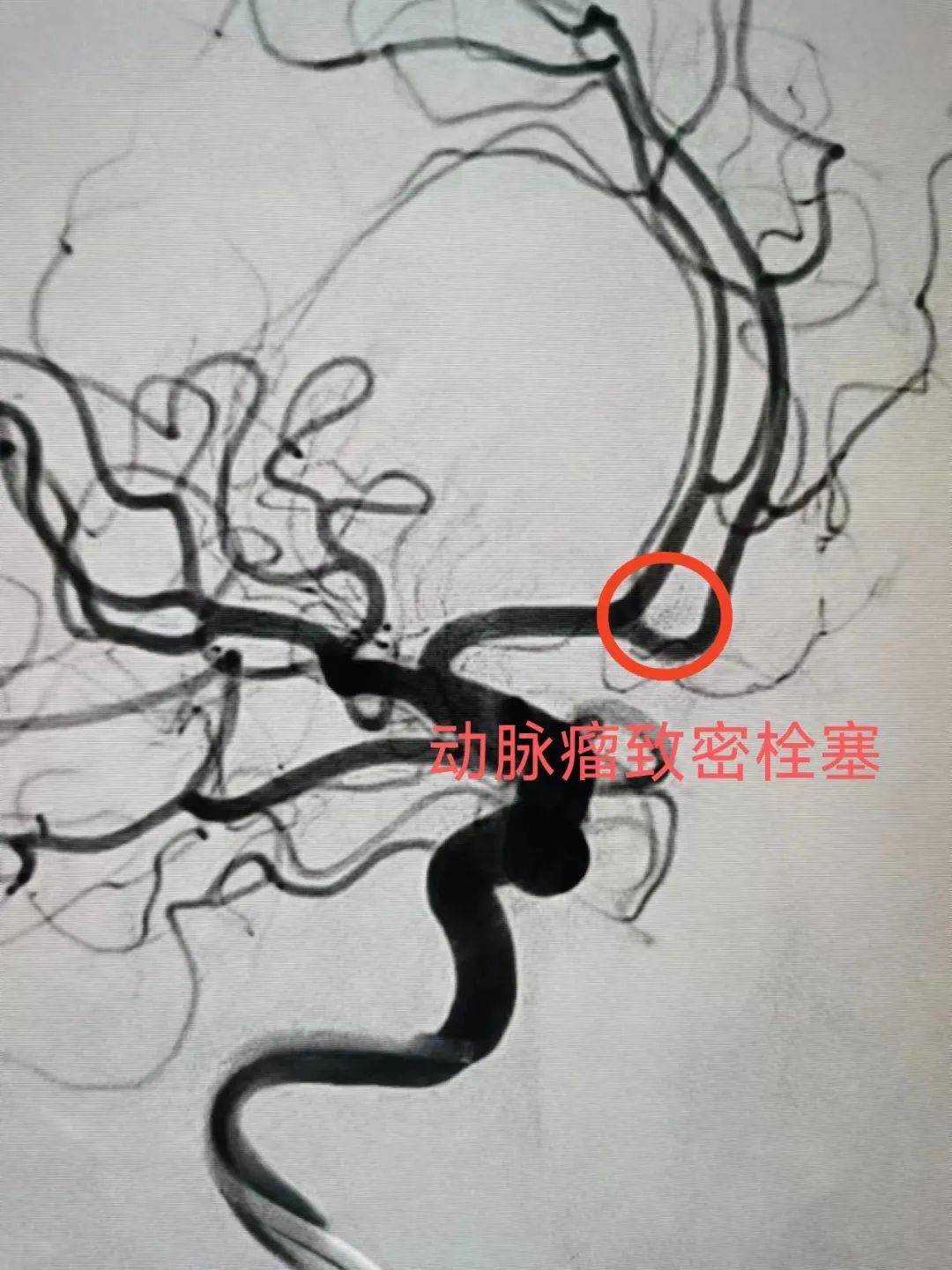 术后7个月患者来我院复诊,复查脑血管造影提示动脉瘤治愈,患者未遗留