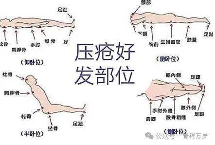 褥疮怎么引起的图片