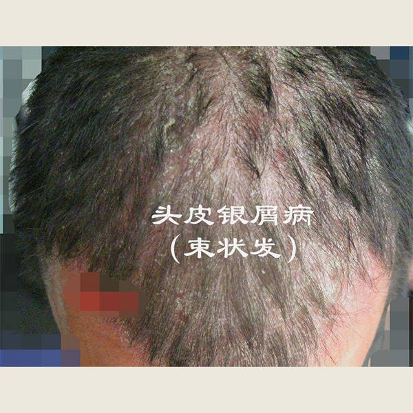 它们产生的原因通常涉及以下几点:皮脂分泌不均衡:头皮上的油脂分泌过