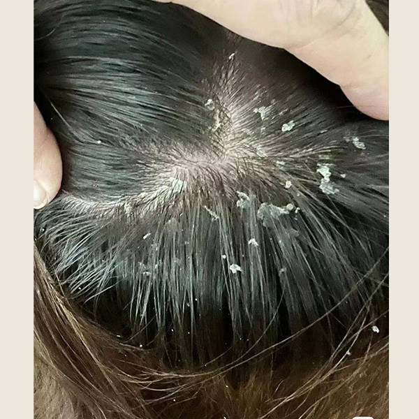 去头屑止痒洗发水排行榜_护理_头皮_头发