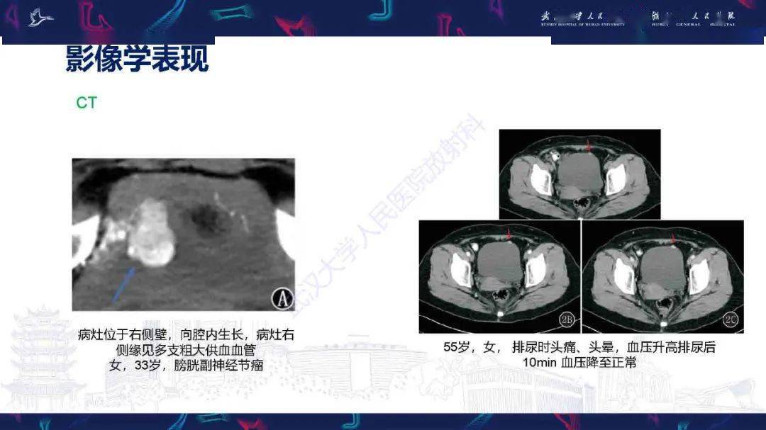 膀胱副神经节瘤影像诊断