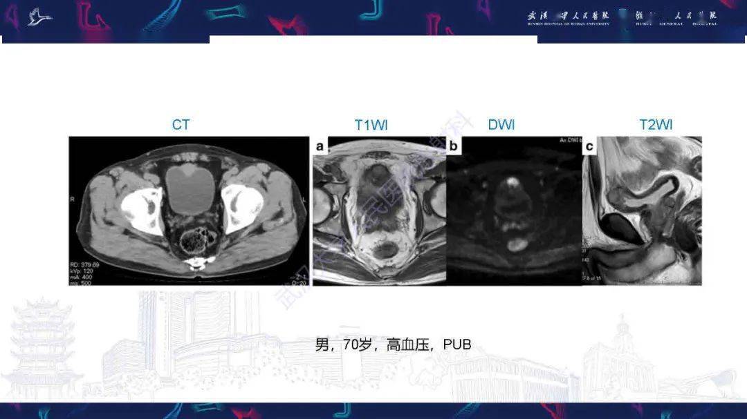 膀胱副神经节瘤影像诊断