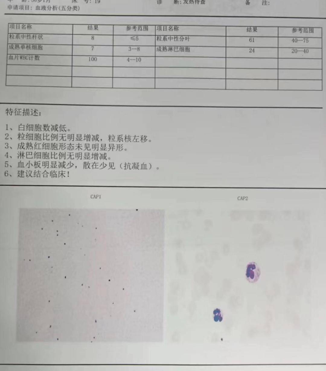 急性淋巴细胞白血病伴细菌性脑膜炎