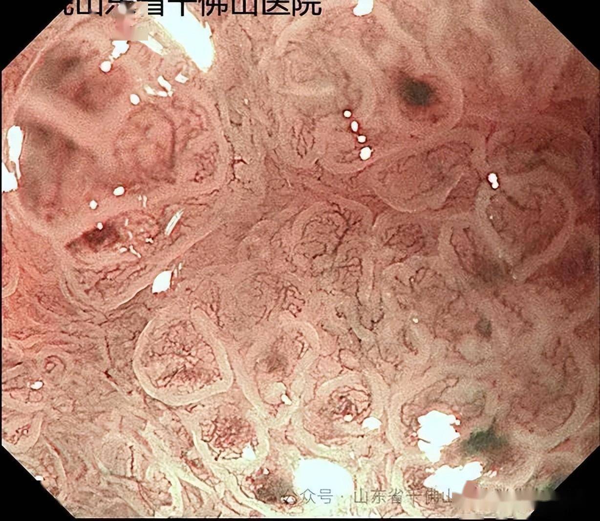 患者胃窦部黏膜光滑,无萎缩及炎症表现,胃底穹窿大弯见一直接约4.