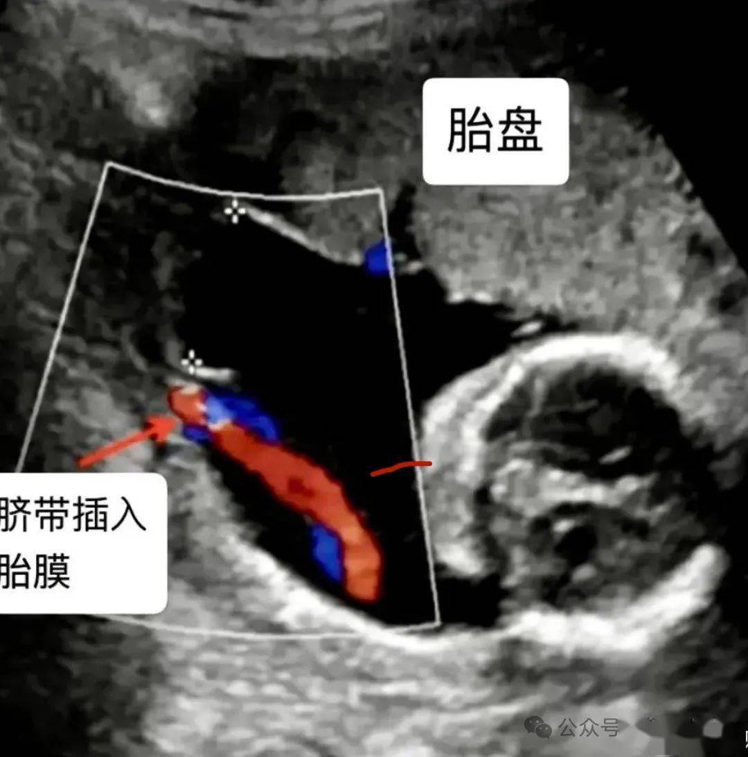 胎盘图片超声图片