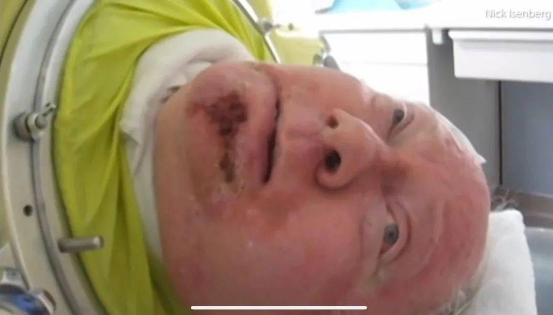 活在罐子里70年地球上最后一个铁肺人去世了