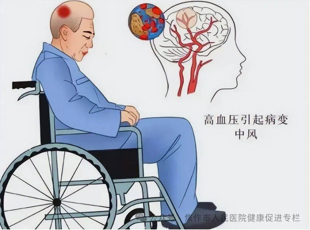 脑卒中患者图片