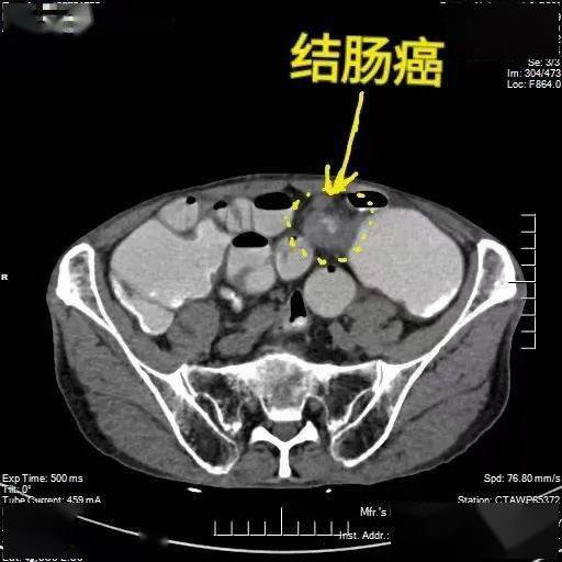 结肠癌影像图片图片