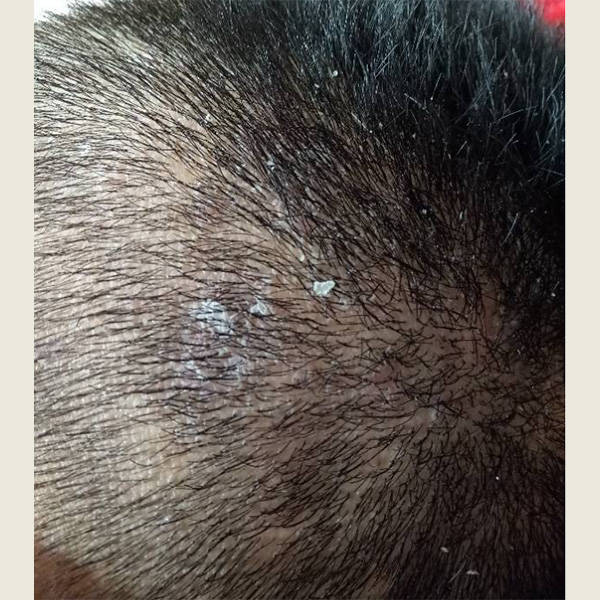 头皮屑_头发_效果