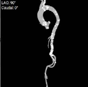 双侧股动脉中低分叉,双侧髂总动脉-胸主动脉动脉见大量钙化团块,部分