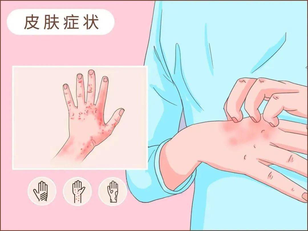 如皮疹和瘙痒.症状通常出现在接触尘螨过敏原后的皮肤部位.