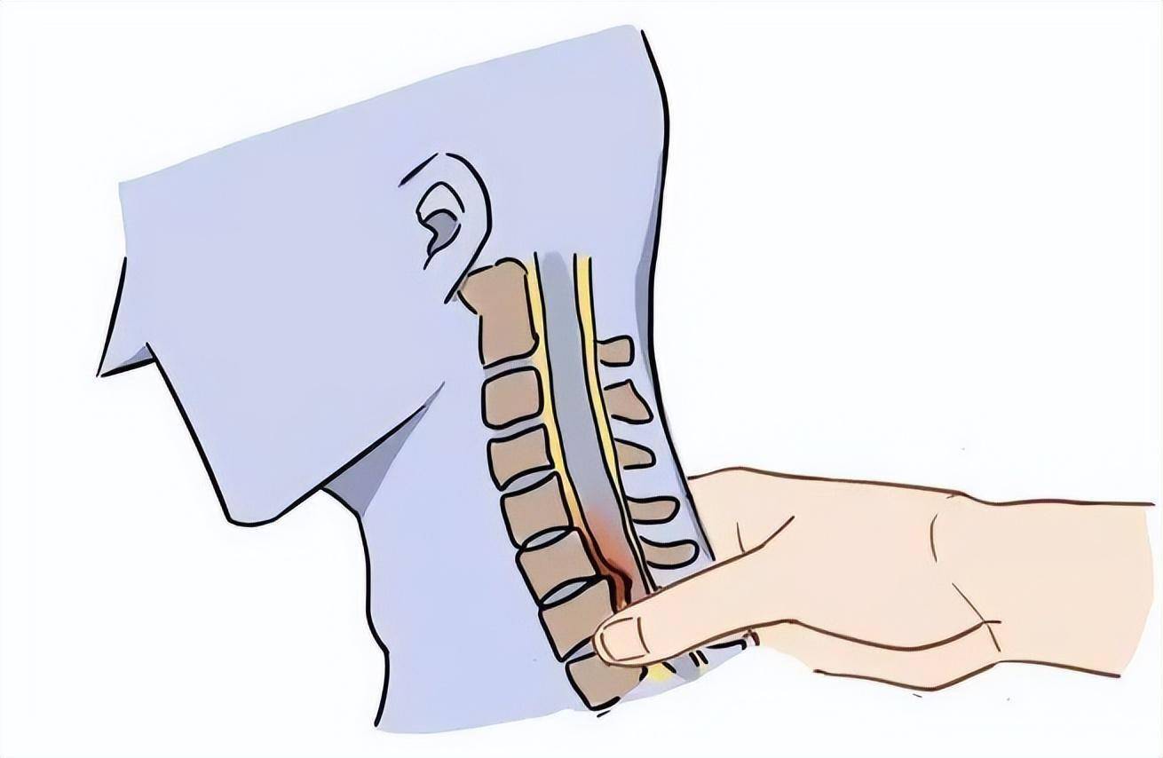 【科普大讲堂】颈椎间盘,为何你如此突出?