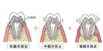 不可忽视的牙周炎_牙齿_进行_治疗
