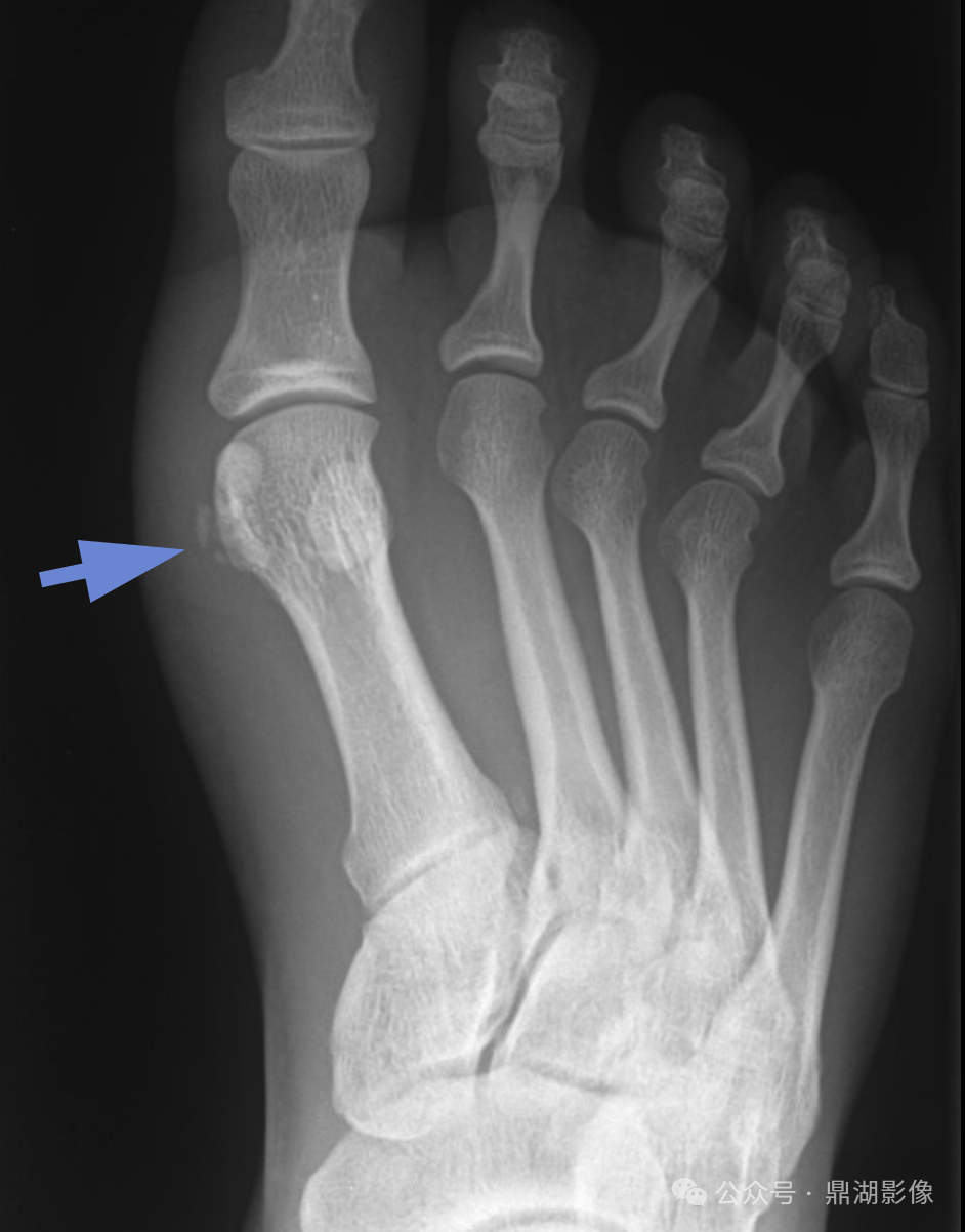 x线示环指近端指间关节桡侧和掌侧周围的曲线软组织钙化.