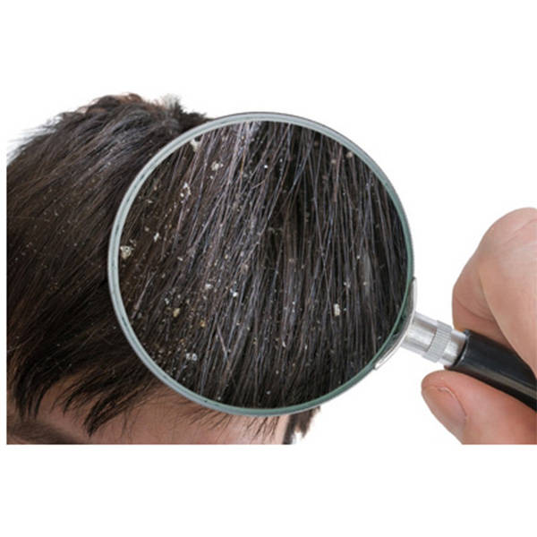 男孩有头屑用什么洗发水男士去屑防脱洗发水排行