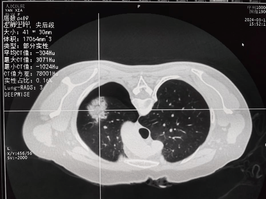 肺肿瘤治疗新选择州人民医院凤仪分院综合外科开展首例肺肿瘤复合式