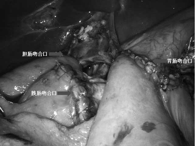 钟晓滢医师在全麻下成功实施完全机器人下保留幽门的胰十二指肠切除术