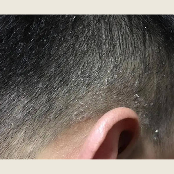 男去屑洗发水哪个牌子好用