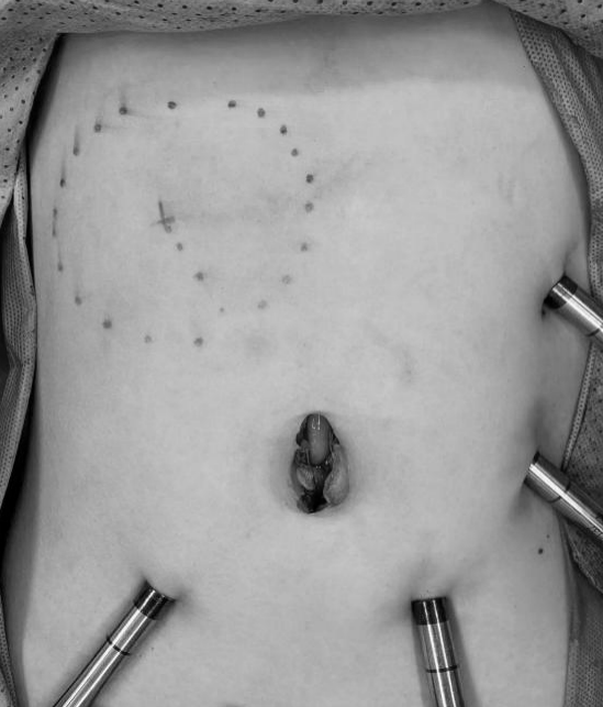 67增新院儿童机器人whipple手术再立新功胃肠外科成