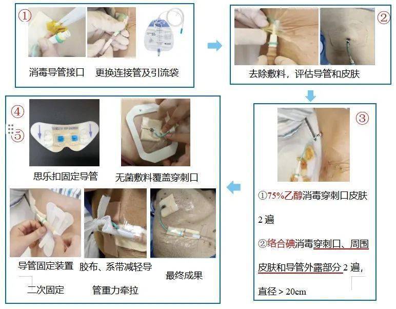 管注细节手护有道科室ptcd管道规范化管理经验分享