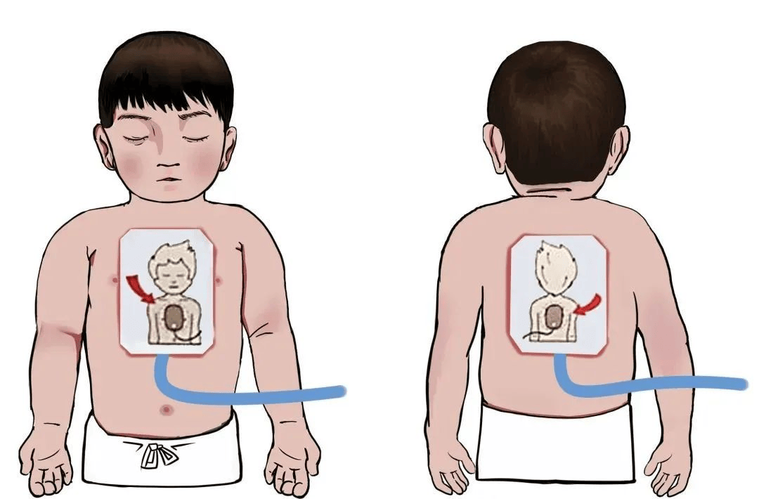 婴儿和儿童电极片贴放位置根据aed电极片上的图示,将一片电极片贴在