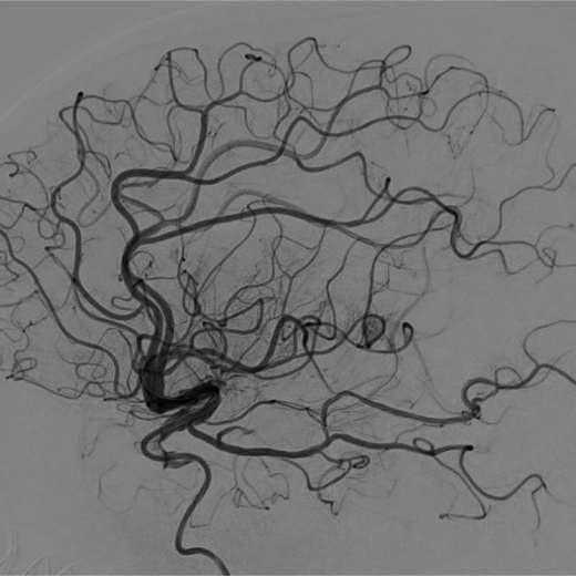 中国神介500人群病例集锦第239期左侧大脑中动脉慢性闭塞再通治疗1例