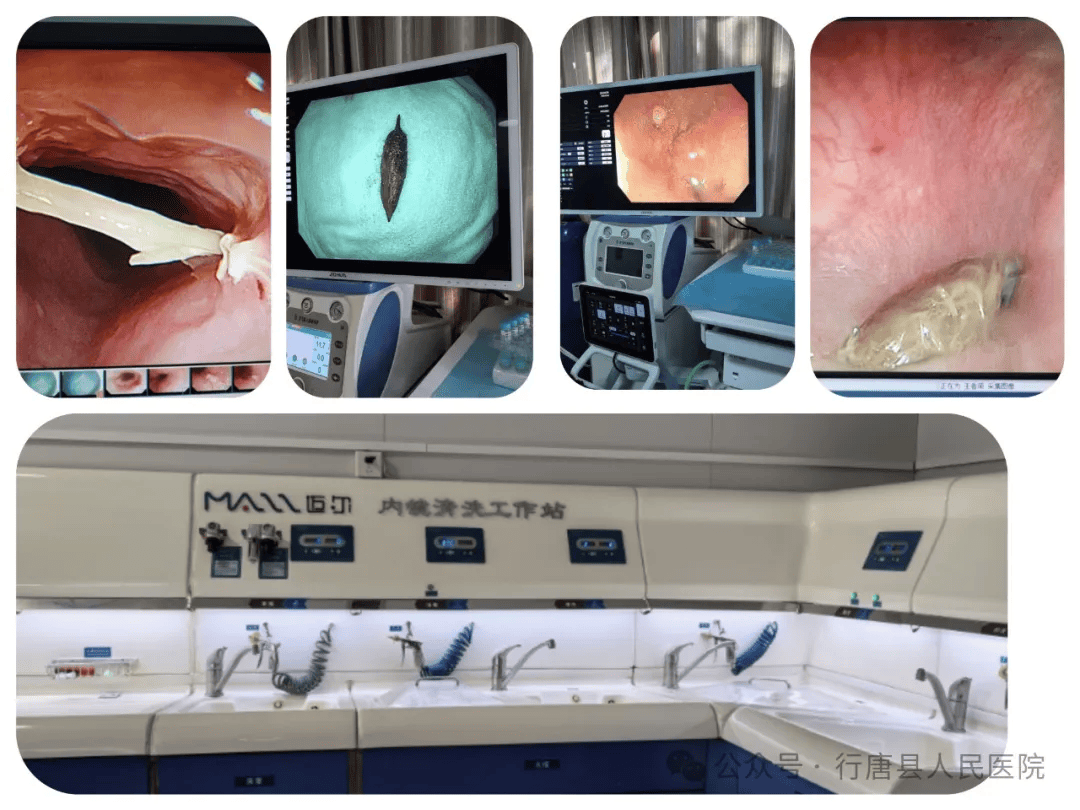 捍"胃"健康,经"肠"检查_内镜_肿瘤_消化道