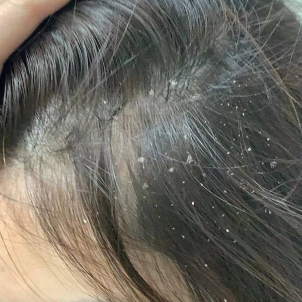 头皮屑是头皮上脱落的小片皮肤,通常由以下原因产生:皮脂分泌过多或不