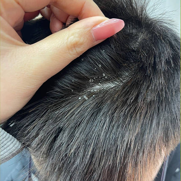 头皮屑红疹等头皮问题产生的原因:头皮屑产生的因素有:皮脂分泌:头皮