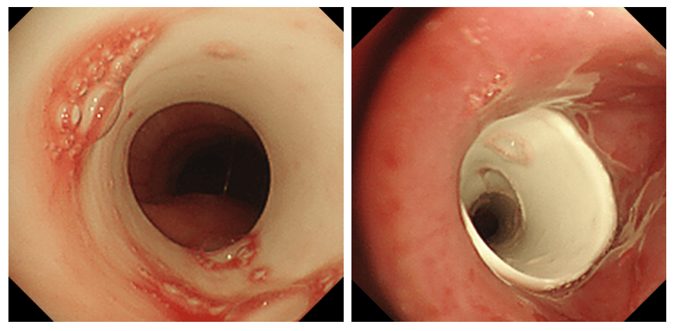 聚焦临床惠州首例市中心人民医院开展气道t管置入术让患者重获新声