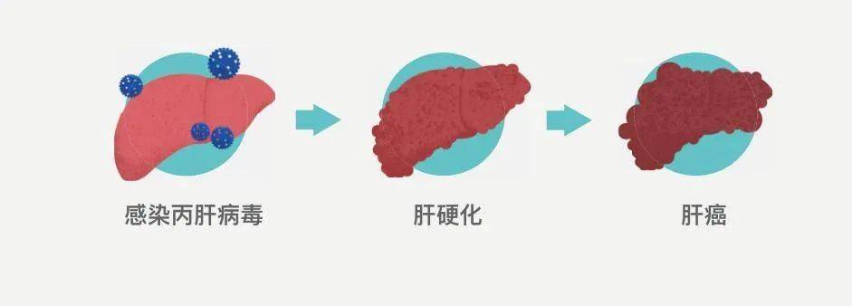 丙型肝炎,简称丙肝,是一种由丙型肝炎病毒(hcv)感染引起的病毒性肝炎