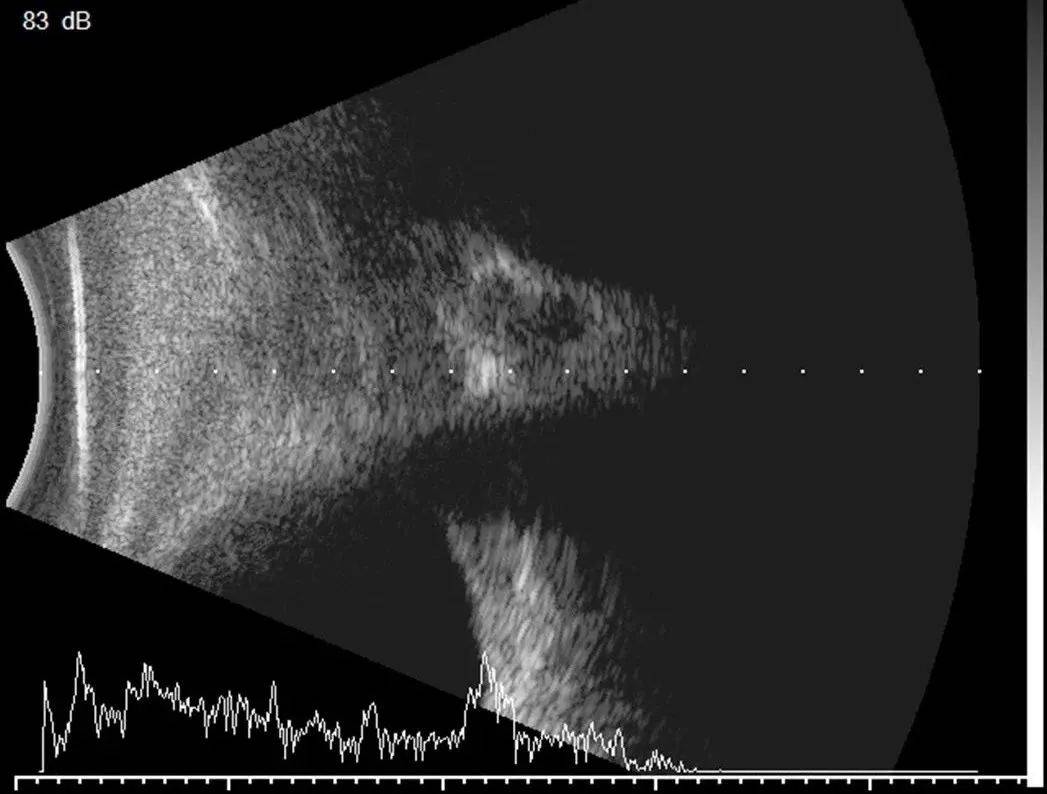 带您了解眼部b超
