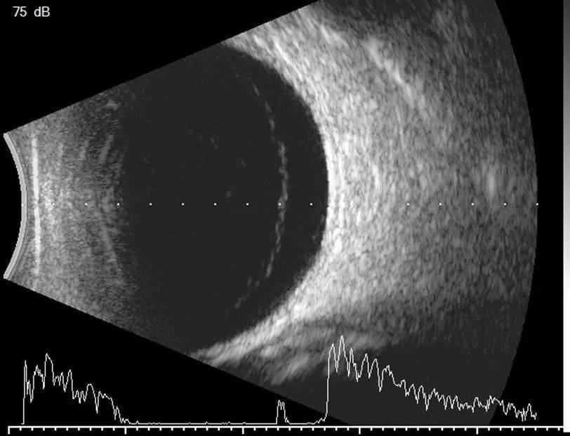 脉络膜脱离超声图图片