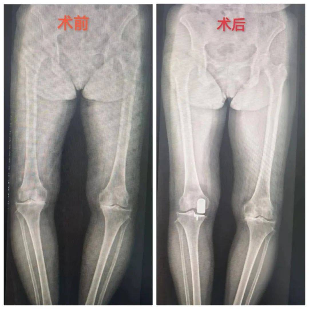 重整膝骨轻松迈步丨膝关节单髁置换为老年患者解决行走之痛
